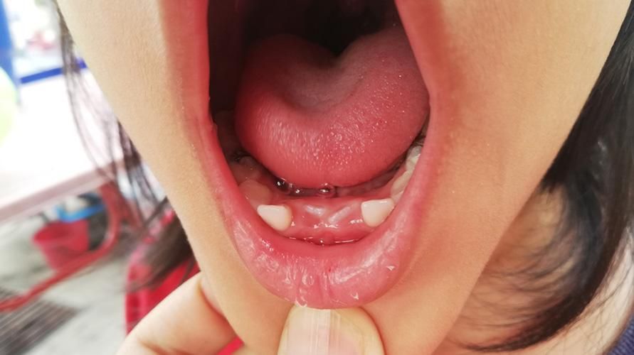 Ανοδοντία, Όταν τα δόντια του παιδιού σας δεν μεγαλώνουν ποτέ