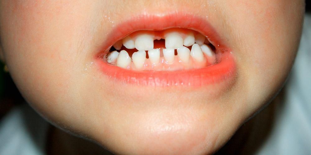 Pöidla imemise harjumused võivad põhjustada lahtiste hammaste
