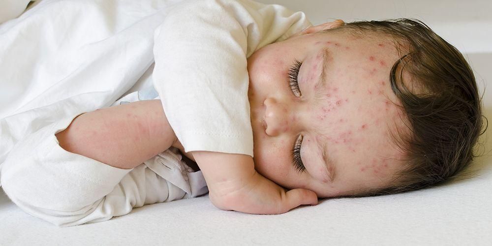Como tratar a varicela é seguro e eficaz em crianças