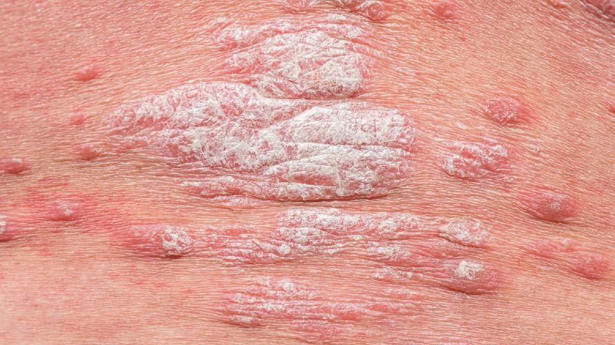 Pozorování příznaků psoriasis gutata, které jsou podobné kapkám vody na kůži
