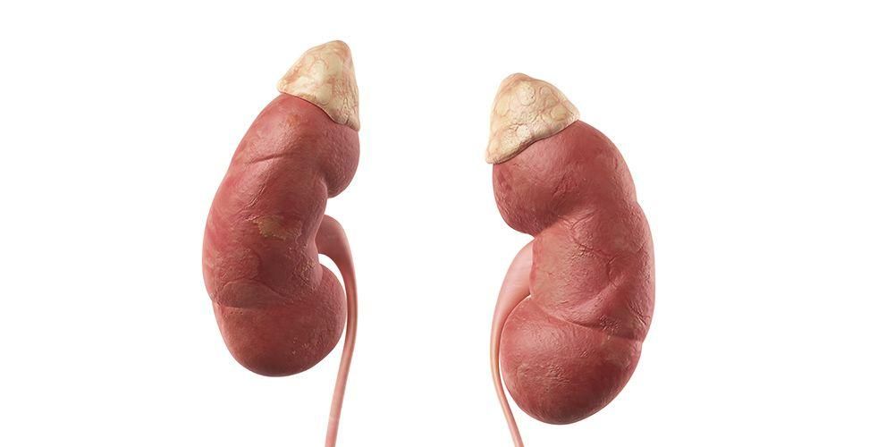 Mga Sintomas ng Kidney Stones sa Mga Lalaki na Dapat Mong Abangan
