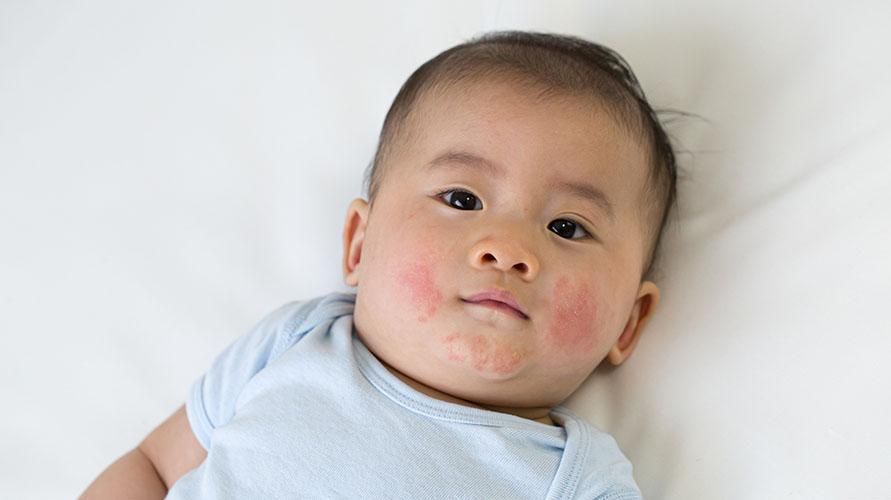 牛奶湿疹导致宝宝脸颊发红，真的是母乳过敏引起的吗？