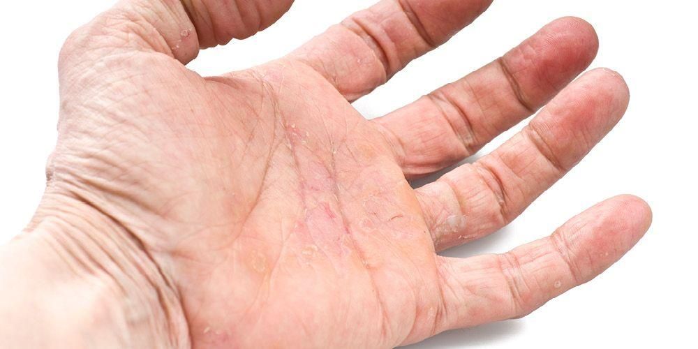 Kontaktní léčba dermatitidy ke zmírnění svědění