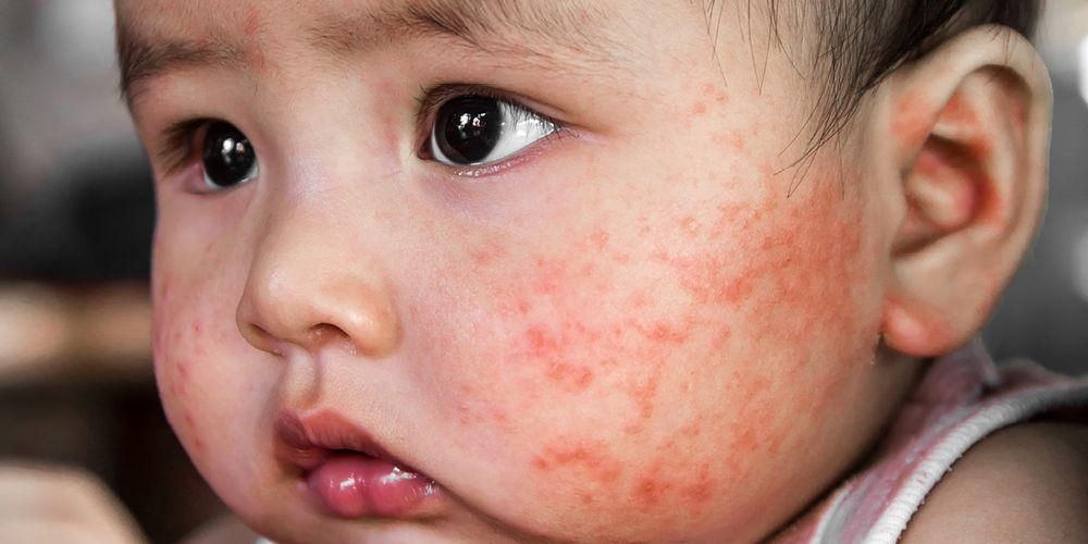 Rozpoznejte různé formy alergií u dětí a jak je léčit