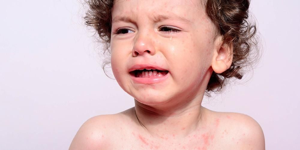 家长应注意的儿童麻疹症状