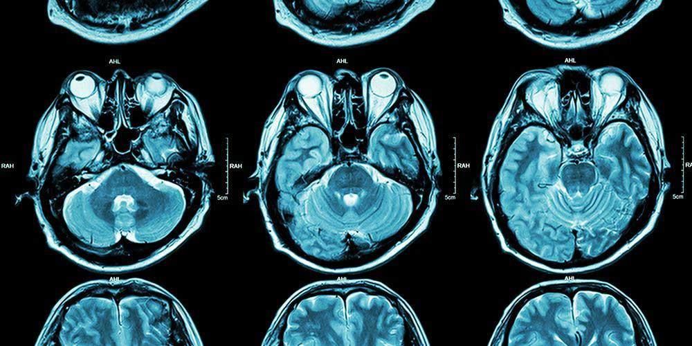 Pomanjkljivosti možganske poškodbe, ki jih je treba vedeti