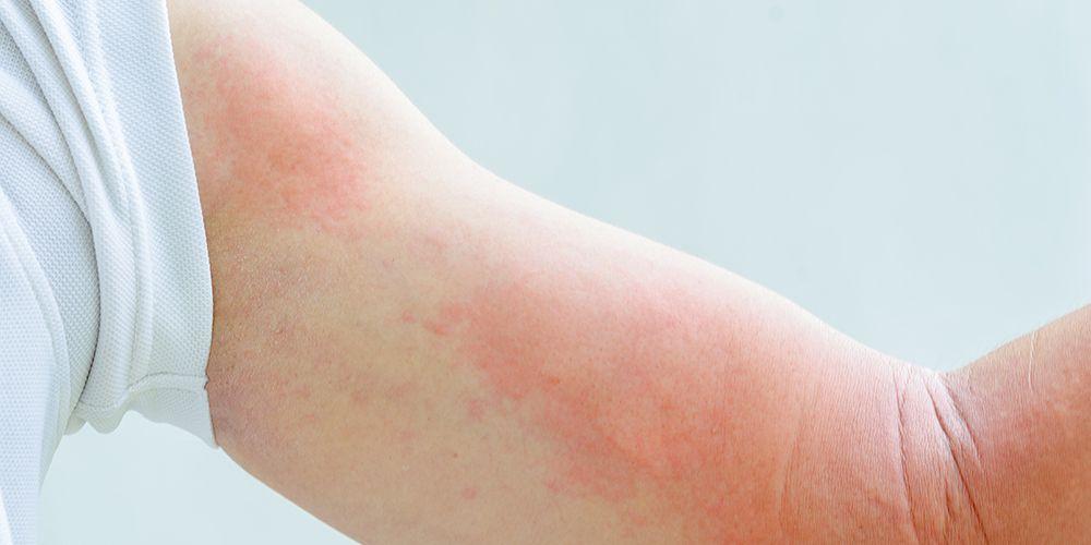 4 Doenças de pele em pele sensível e como tratá-las