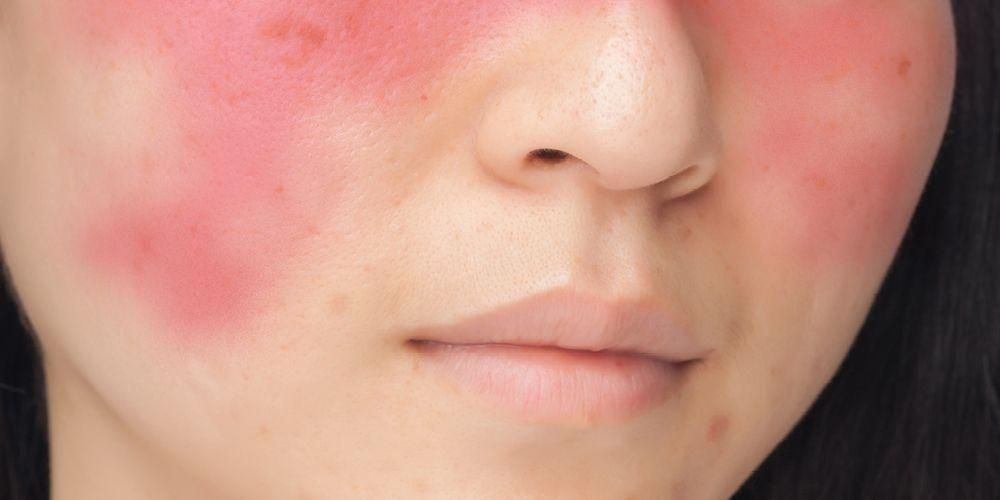 Terapija kože za lupus ni le protivnetna