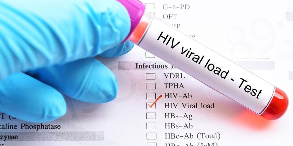 Αναγνώριση ιικού φορτίου HIV στη μέτρηση της ποσότητας του ιού στο σώμα του ασθενούς