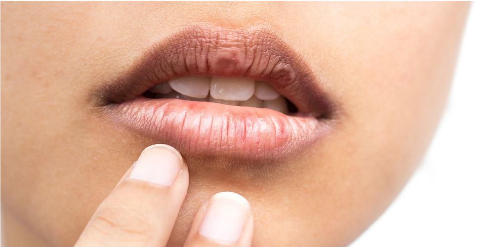 8 maneiras fáceis de superar os lábios secos durante o jejum