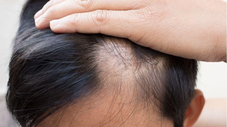 8 vzrokov za izpadanje las pri otrocih in kako ga premagati
