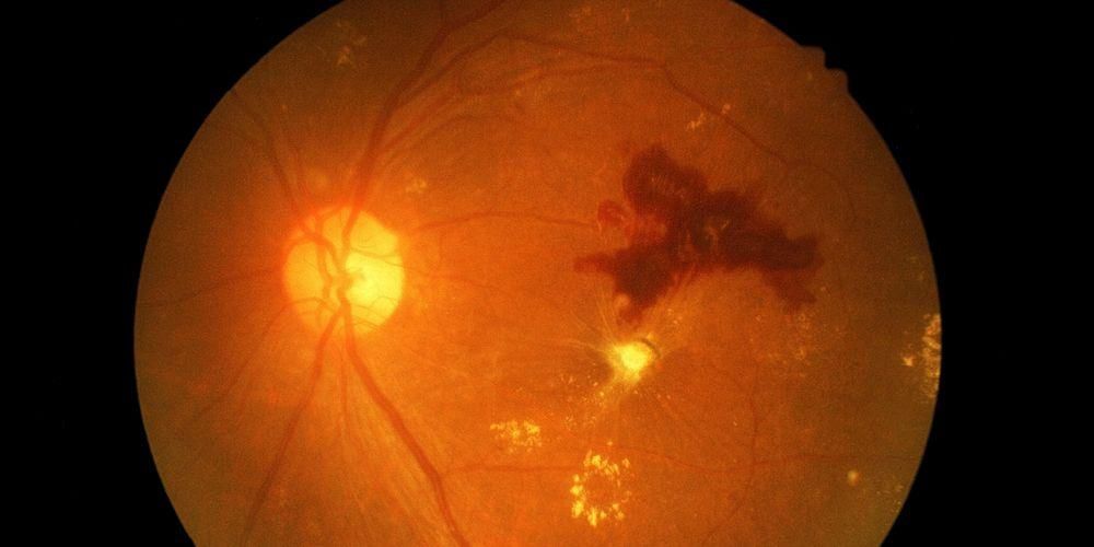 Eylea, nová možnosť v liečbe diabetickej retinopatie