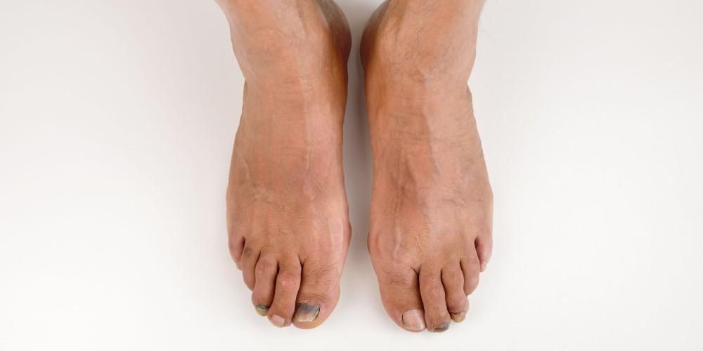 Dits dels peus de Covid, nous símptomes de Covid-19 en forma de lesions morades a les ungles dels peus
