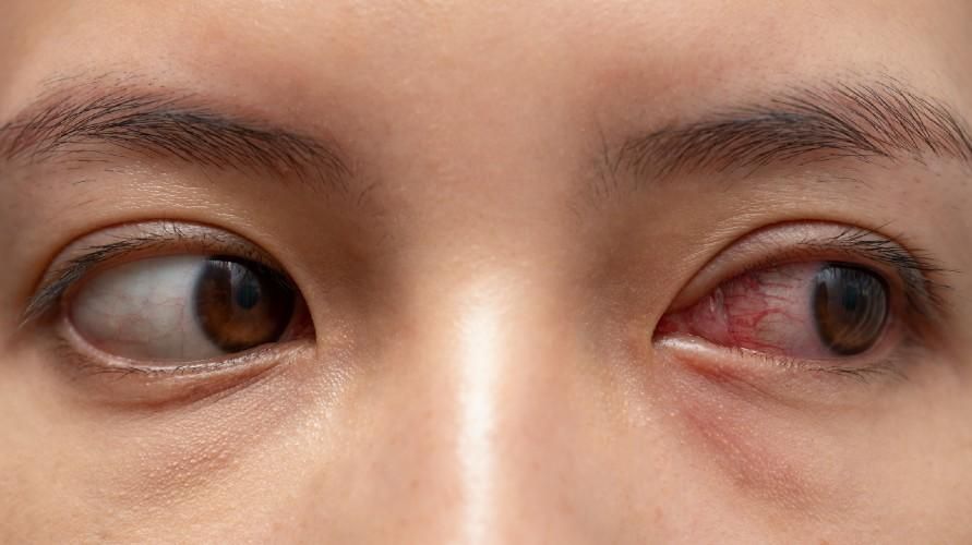 یہ انفیکشن اور الرجی کی وجہ سے ہو سکتا ہے، آشوب چشم کی ان مختلف وجوہات کو دیکھیں