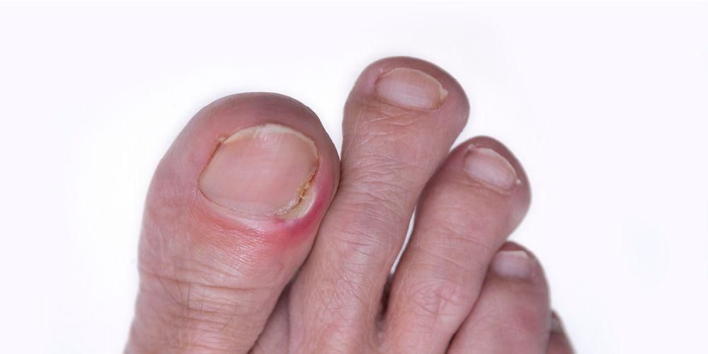 指甲感觉很痛，如何治疗向内生长的脚趾甲？