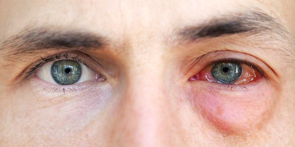 Forskellige årsager til øjenskade og hvordan man overvinder det